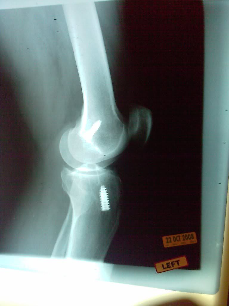 Screws In Left Knee After ACL Surgery 3 Photo by FastRX8 Photobucket